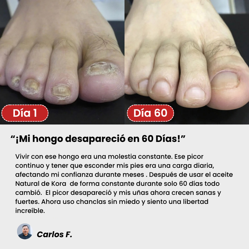 Kora™ Tratamiento Antihongos Triple Acción