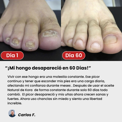 Kora™ Tratamiento Antihongos Triple Acción